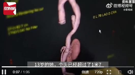 13岁女孩身高超1米7被确诊天才病：四肢修长，双手下垂甚至能超过膝盖