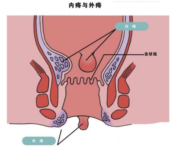 肛门旁边长小肉揪的原因和缓解方法：浅显易懂的知识分享