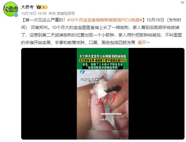 10个月宝宝食指倒刺被拔送PICU抢救：揪倒刺引起严重的感染